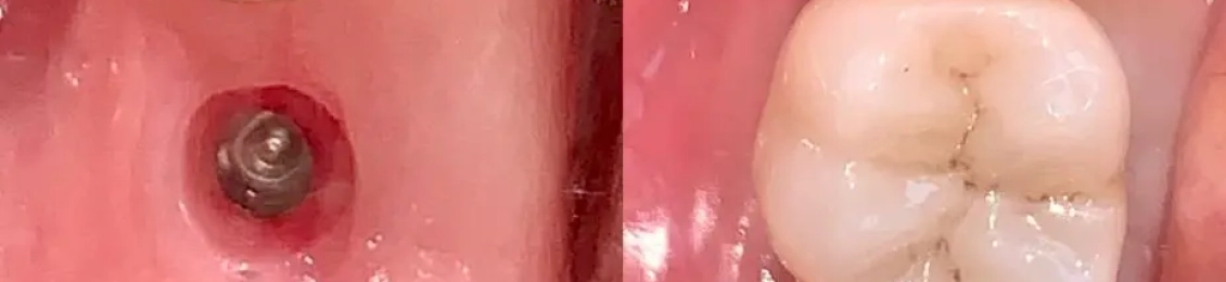 متى تلتئم اللثة بعد زراعة الاسنان؟