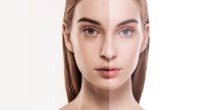 ما هو أفضل علاج تهدل الجفن العلوي بعد البوتكس؟
