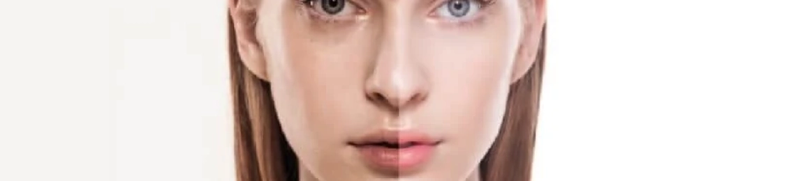 ما هو أفضل علاج تهدل الجفن العلوي بعد البوتكس؟