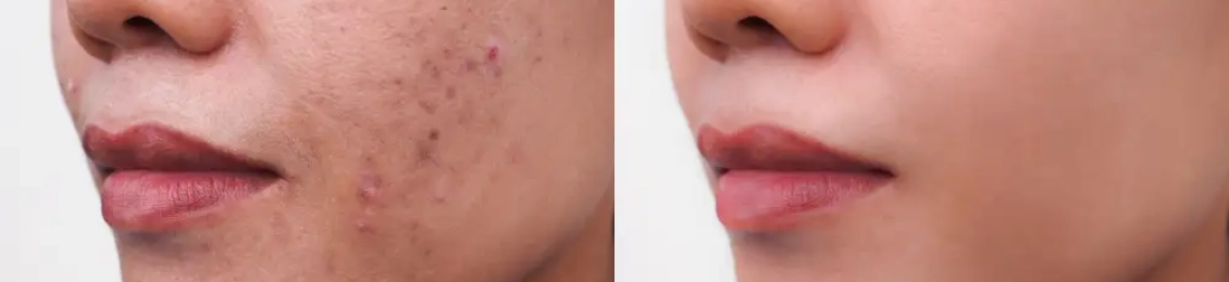 علاج حب الشباب بالليزر: الفوائد والمخاطر والتكلفة