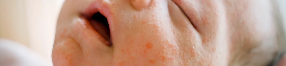 علاج حساسية الجلد المفاجئة عند الأطفال بطرق آمنة وفعّالة