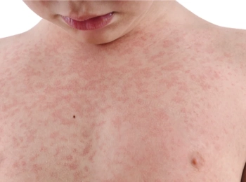 علاج حساسية الجلد عند الأطفال من الأكل وما هي أسبابها