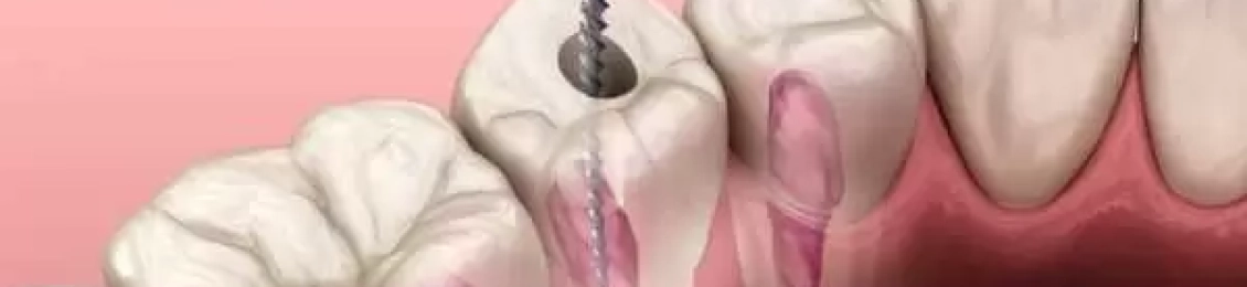 طريقة حشو العصب للضرس خطوة بخطوة مع الطبيب