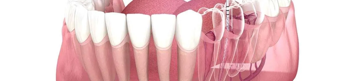 اسعار حشو عصب الضرس في المدينة المنورة: تكلفة متوقعة حسب الحالة