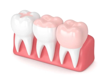 افضل حشو للاسنان للاطفال والكبار في المدينة المنورة