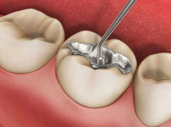 أفضل حشو للاسنان وكيف تختار الأنسب لك؟