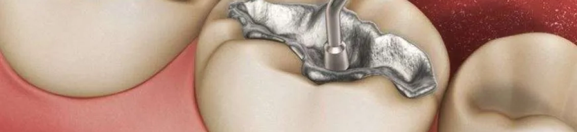 أفضل حشو للاسنان وكيف تختار الأنسب لك؟