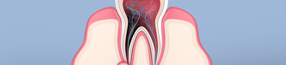 ما هي أسباب ظهور خراج بعد زراعة الأسنان