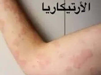 افضل دكتور لعلاج حساسية الجلد والوقاية منها