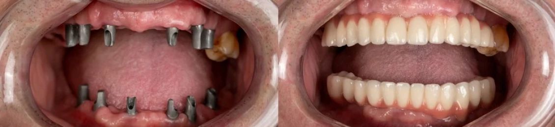 مجمع الطب المتميز: اهم مركز زراعة اسنان في المدينة المنورة 