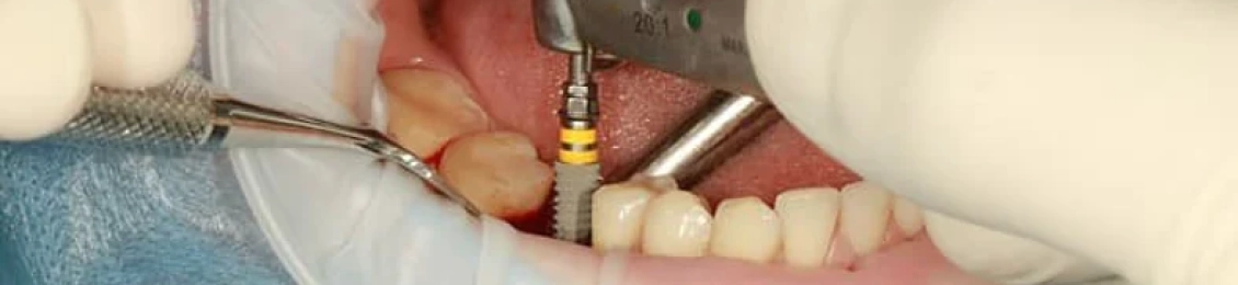 حالات زراعة الأسنان: من هم المرشحون المثاليون؟