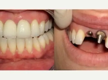 ما هي طريقة زراعة الأسنان الأمامية مع د.محمد بشار