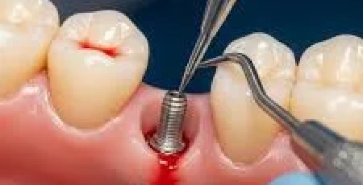 شروط زراعة الأسنان الناجحة: ما يجب معرفته قبل العملية