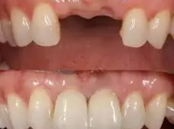 ماذا بعد زراعة الاسنان مع د.محمد بشار