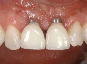 ما هي التعليمات بعد زراعة الاسنان اليوم الاول؟