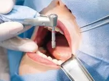 هل زراعة الاسنان تؤلم وما هي انواعها؟