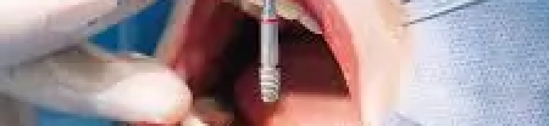 هل زراعة الاسنان تؤلم وما هي انواعها؟