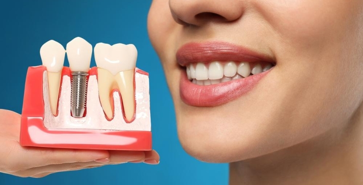 تكلفة زراعة طقم أسنان كامل في المدينة المنورة