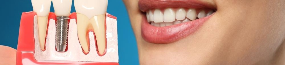 تكلفة زراعة طقم أسنان كامل في المدينة المنورة