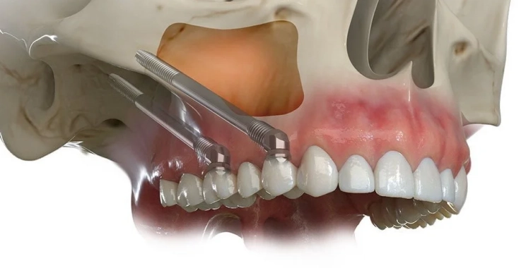 تكلفة زراعة عظم الفك: من تحديد السعر إلى العوامل المؤثرة