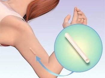 تركيب شريحة منع الحمل بدون ألم مع مجمع الطب المتميز