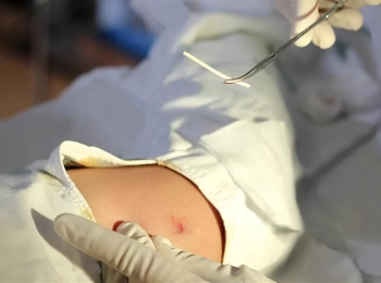 فوائد شريحة منع الحمل  مقارنة بوسائل أخرى