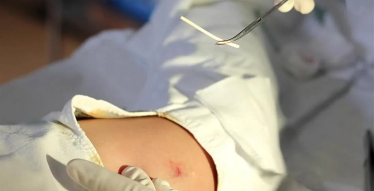 فوائد شريحة منع الحمل  مقارنة بوسائل أخرى