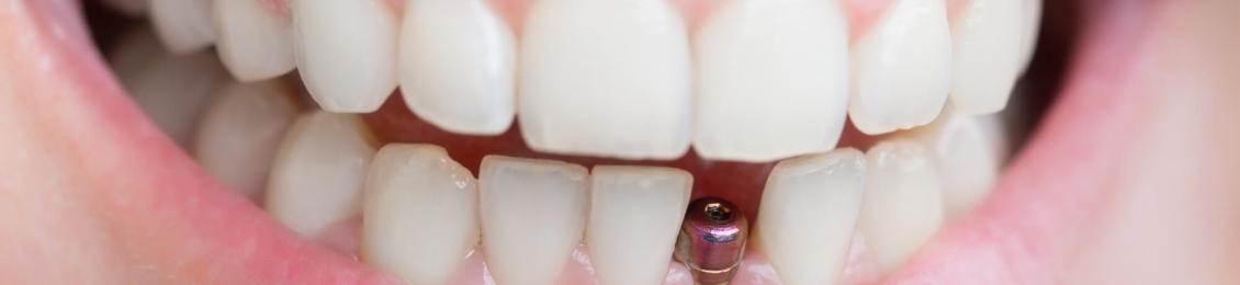 مراحل زراعة ضرس بعد الخلع مع افضل الاطباء