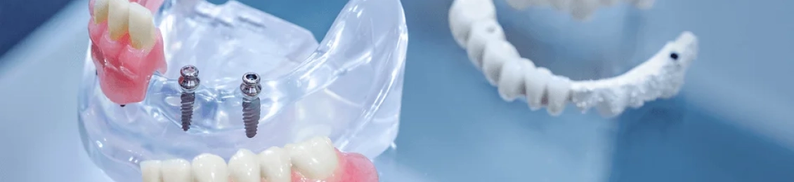 هل تفكر في زراعة طقم أسنان كامل؟ تعرف على الخطوات