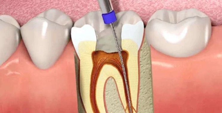 علاج عصب الأسنان كم يكلف؟ تعرف على الأسعار والعوامل المؤثرة