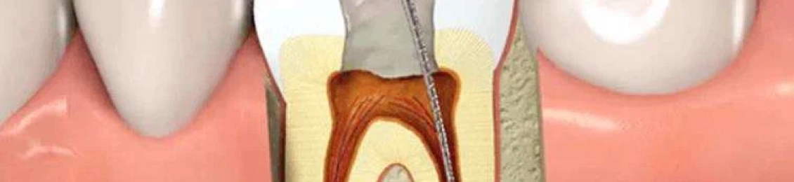 علاج عصب الأسنان كم يكلف؟ تعرف على الأسعار والعوامل المؤثرة