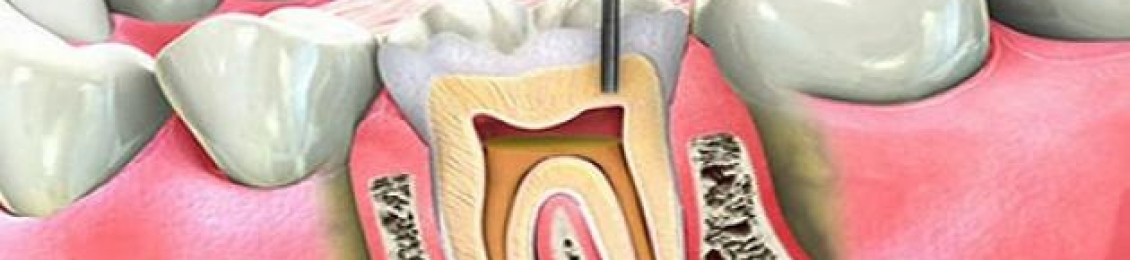 اعراض التهاب عصب الاسنان وما هي المخاطر