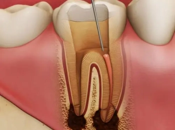 ما هو حشو عصب الاسنان وانواعه في مجمع الطب المتميز