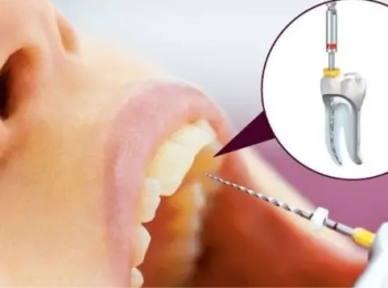 طرق ازالة عصب الاسنان الصحيحة مع د.طارق ابوحماد