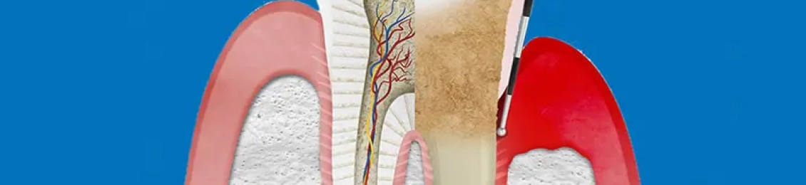 كيف يمكن علاج عصب الضرس المكشوف مع د.احمد حسن