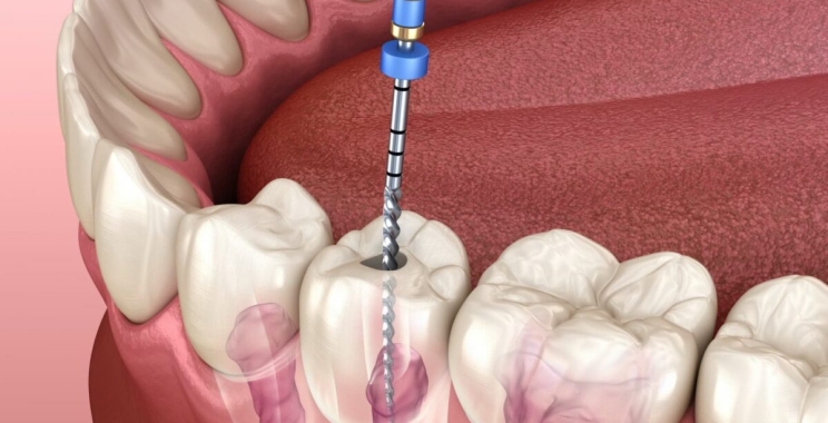 ما علاقة التهاب عصب الضرس والصداع؟