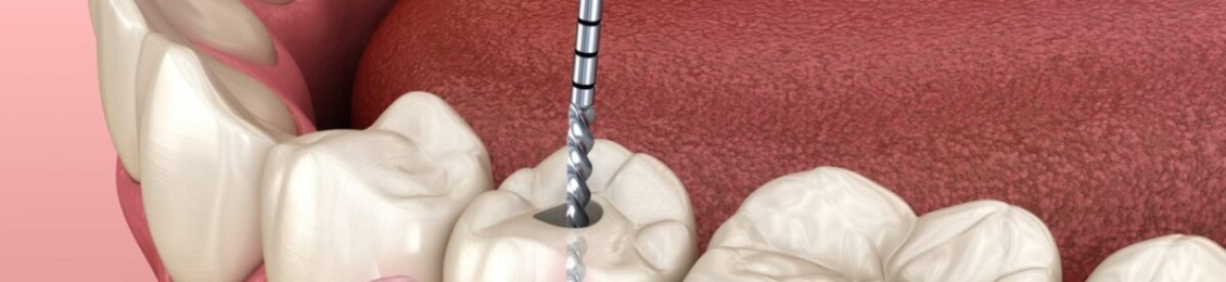 ما علاقة التهاب عصب الضرس والصداع؟