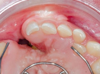 زراعة عظم في اللثة: الأسباب، الخطوات، ومدة التعافي بعد العملية