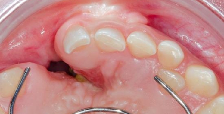 زراعة عظم في اللثة: الأسباب، الخطوات، ومدة التعافي بعد العملية