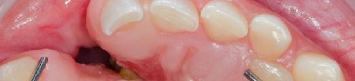 زراعة عظم في اللثة: الأسباب، الخطوات، ومدة التعافي بعد العملية