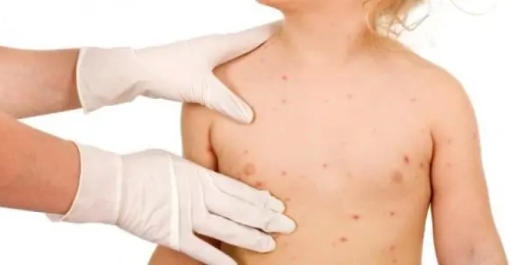 مدة علاج الجدري عند الأطفال: الأعراض، المراحل وطرق العلاج والوقاية