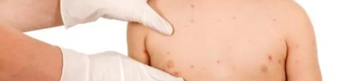 مدة علاج الجدري عند الأطفال: الأعراض والمراحل وطرق العلاج والوقاية