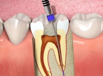 هل إعادة علاج العصب مؤلم؟