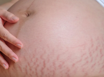 هل علامات التمدد الحمراء تختفي؟ 4 طرق مهمة للعلاج بفاعلية