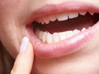 أعراض فشل زراعة الأسنان المبكرة وكيفية إنقاذ الزراعة قبل فوات الأوان