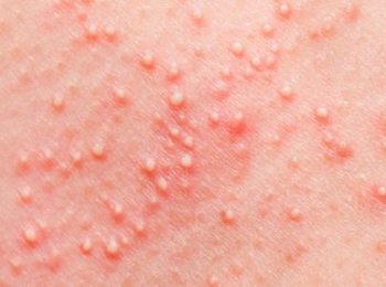 ما هي فطريات الجلد البيضاء مع د.زينب جلال