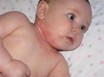 د.زينب جلال: افضل دكتور علاج فطريات الجلد عند الاطفال