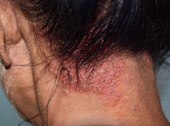 تعرف على اسباب الفطريات الجلدية مع د.زينب جلال