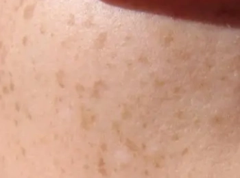 افضل طريقة علاج فطريات الجلد البنية مع د.زينب جلال