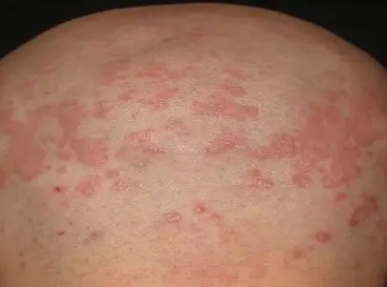 افضل علاج فطريات الراس بطرق فعالة 